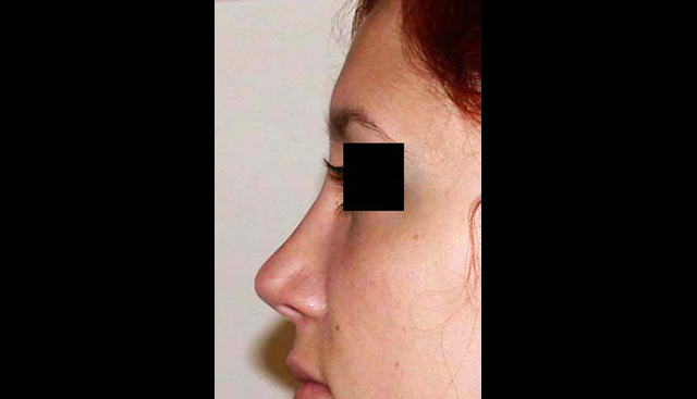 chirurgie-esthetique-interventions-nez-rhinoplasties
