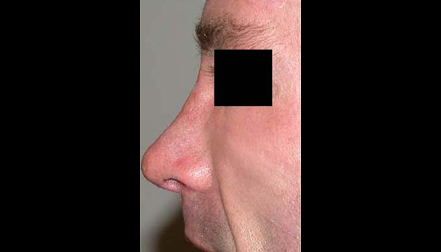 chirurgie-esthetique-interventions-nez-rhinoplasties