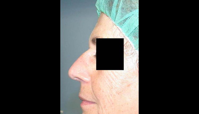 chirurgie-esthetique-interventions-nez-rhinoplasties