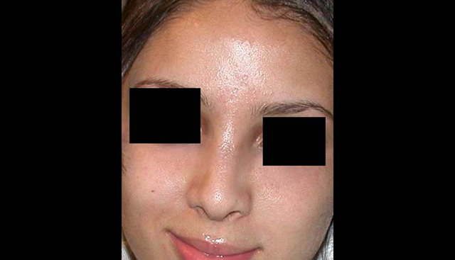 chirurgie-esthetique-interventions-nez-rhinoplasties