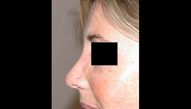 chirurgie-esthetique-interventions-nez-rhinoplasties
