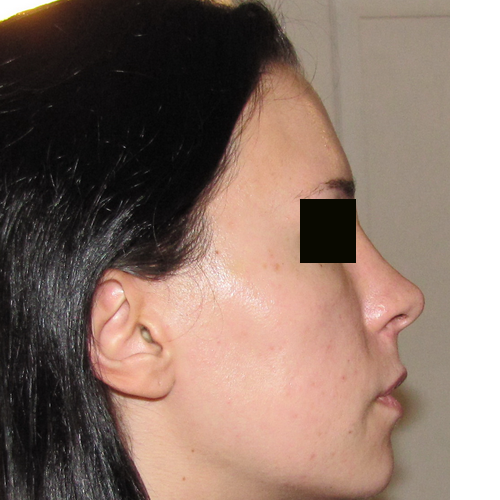 même patiente opérée de profil