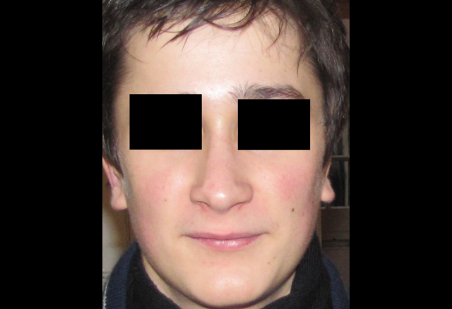 Rhinoplastie globale