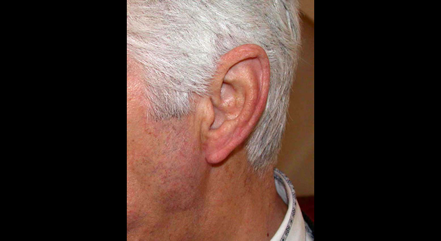 chirurgie-esthetique-pierre-nahon-interventions-oreilles-01