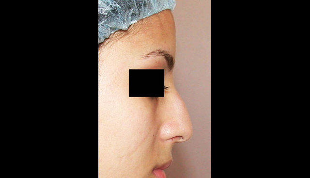 chirurgie-esthetique-interventions-nez-rhinoplasties