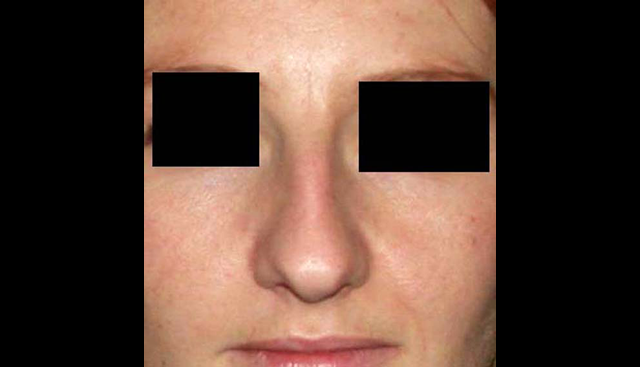 chirurgie-esthetique-interventions-nez-rhinoplasties