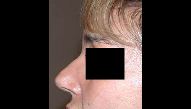 chirurgie-esthetique-interventions-nez-rhinoplasties