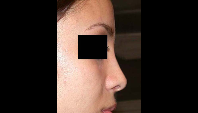 chirurgie-esthetique-interventions-nez-rhinoplasties
