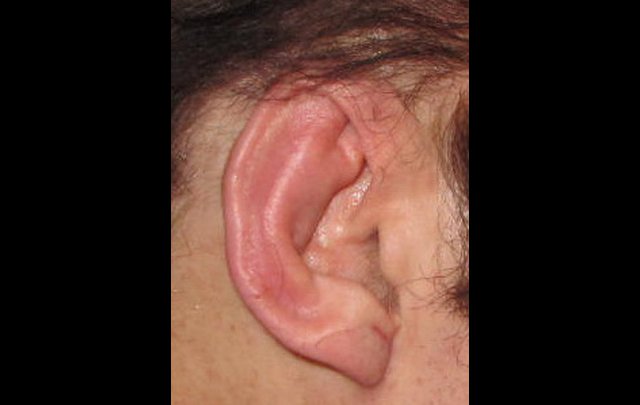 réduction d'oreilles