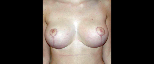 chirurgie-esthetique-interventions-seins-reductions-mammaires