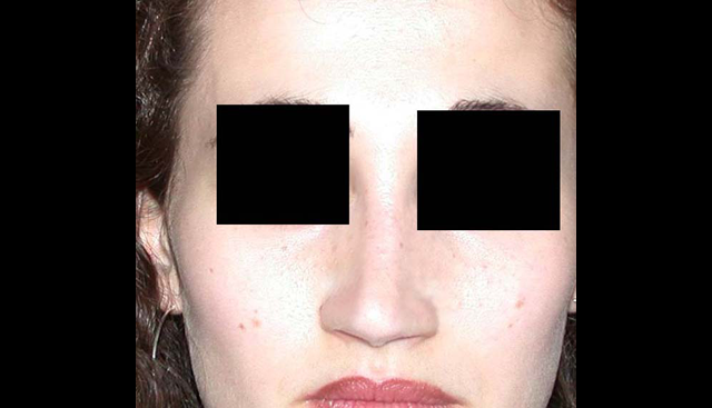 chirurgie-esthetique-interventions-nez-rhinoplasties