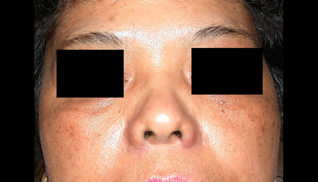 chirurgie-esthetique-interventions-nez-rhinoplasties