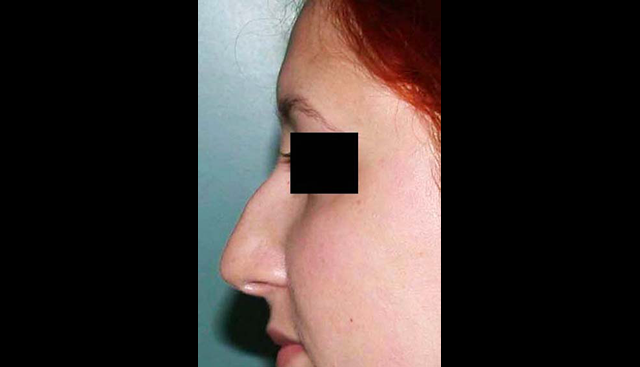 chirurgie-esthetique-interventions-nez-rhinoplasties
