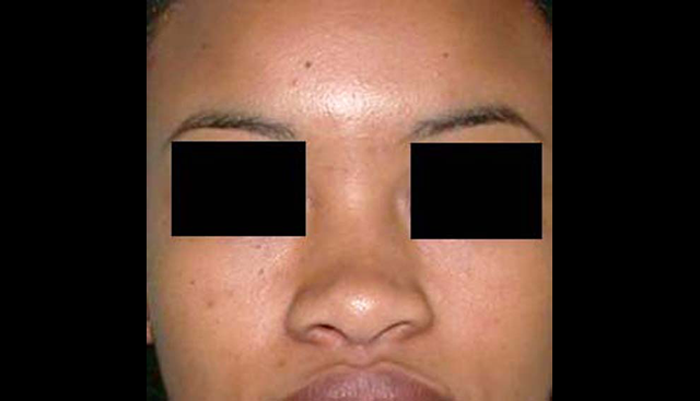 chirurgie-esthetique-interventions-nez-rhinoplasties
