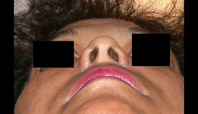 chirurgie-esthetique-interventions-nez-rhinoplasties