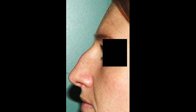 chirurgie-esthetique-interventions-nez-rhinoplasties
