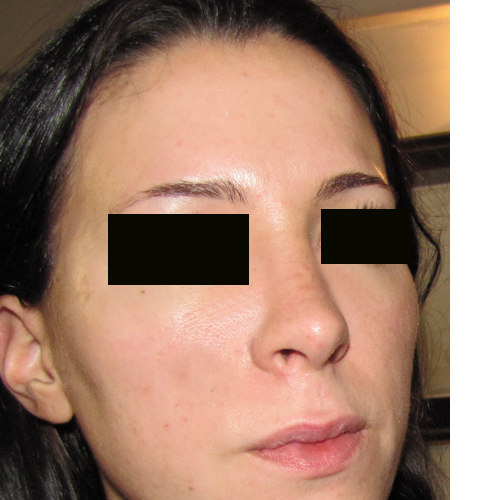 patiente au 10ème jour