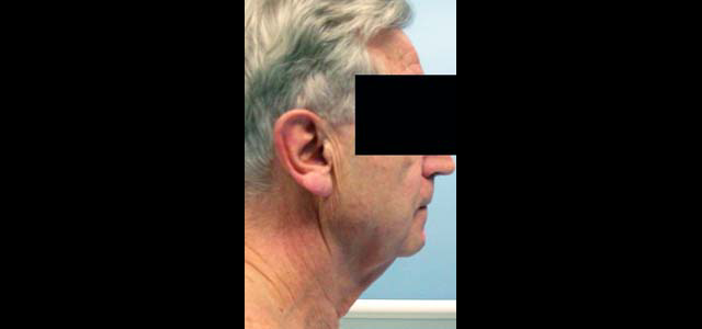 chirurgie-esthetique-interventions-visage-liftings