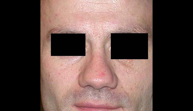 chirurgie-esthetique-interventions-nez-rhinoplasties