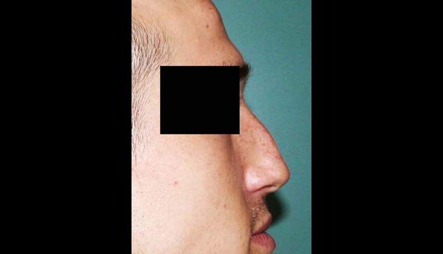 chirurgie-esthetique-interventions-nez-rhinoplasties