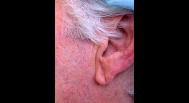 chirurgie-esthetique-pierre-nahon-interventions-oreilles-00