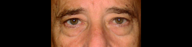 chirurgie-esthetique-interventions-paupieres-blépharoplasties