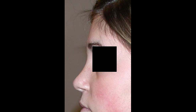 chirurgie-esthetique-interventions-nez-rhinoplasties