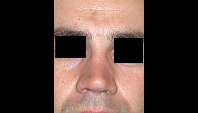 chirurgie-esthetique-interventions-nez-rhinoplasties