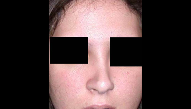 chirurgie-esthetique-interventions-nez-rhinoplasties