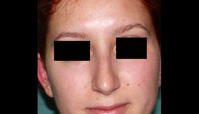 chirurgie-esthetique-interventions-nez-rhinoplasties