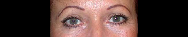 chirurgie-esthetique-interventions-paupieres-blépharoplasties