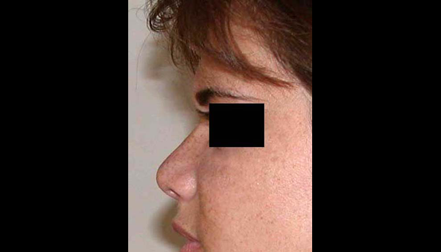 chirurgie-esthetique-interventions-nez-rhinoplasties