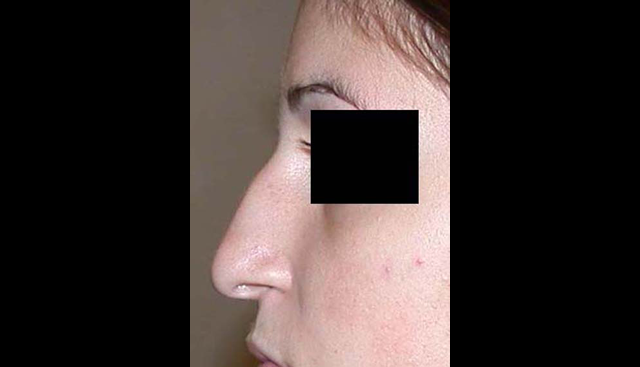 chirurgie-esthetique-interventions-nez-rhinoplasties