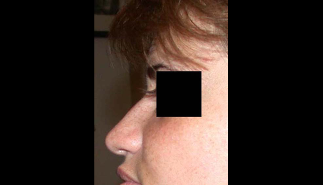chirurgie-esthetique-interventions-nez-rhinoplasties