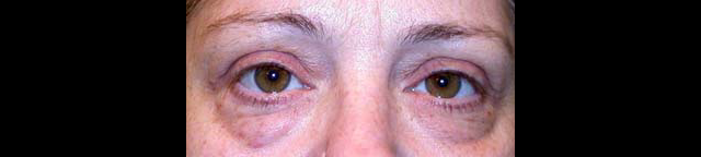 chirurgie-esthetique-interventions-paupieres-blépharoplasties