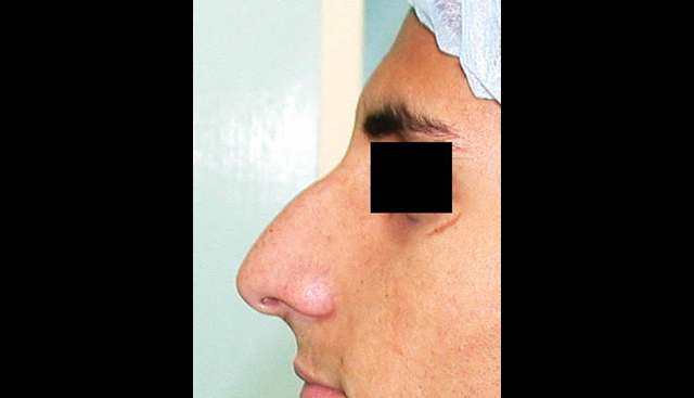 chirurgie-esthetique-interventions-nez-rhinoplasties
