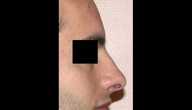 chirurgie-esthetique-interventions-nez-rhinoplasties