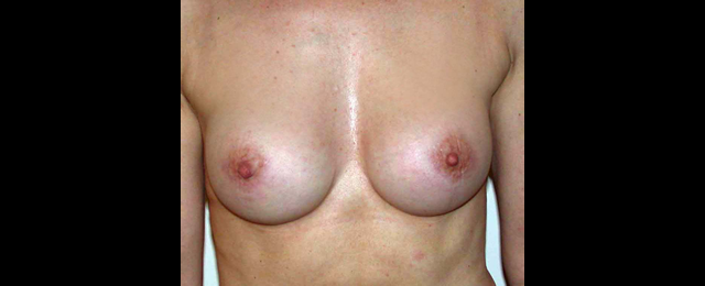 chirurgie-esthetique-interventions-seins-augmentations-mammaires
