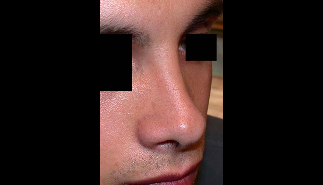 chirurgie-esthetique-interventions-nez-rhinoplasties