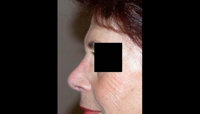 chirurgie-esthetique-interventions-nez-rhinoplasties