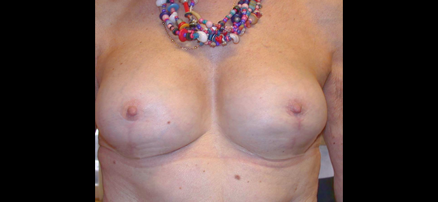chirurgie-esthetique-interventions-chirurgie-secondaire-seins