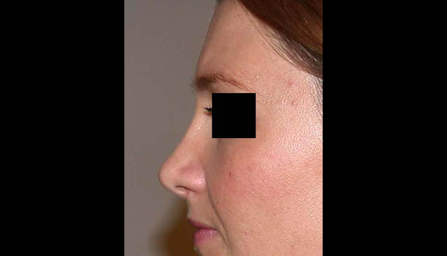 chirurgie-esthetique-interventions-nez-rhinoplasties