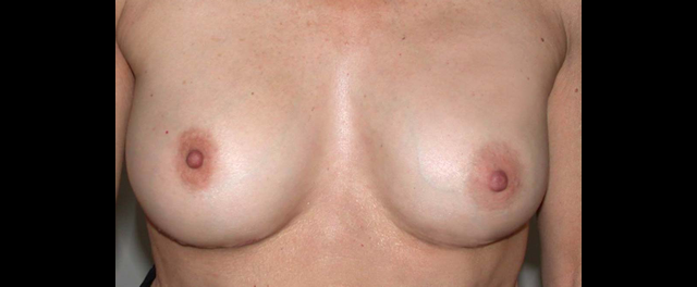 chirurgie-esthetique-interventions-chirurgie-secondaire-seins