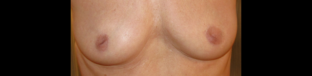 chirurgie-esthetique-interventions-seins-mamelons-rentres