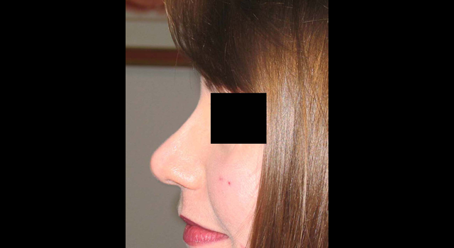 chirurgie-esthetique-interventions-nez-rhinoplasties