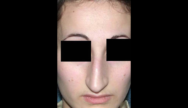 chirurgie-esthetique-interventions-nez-rhinoplasties