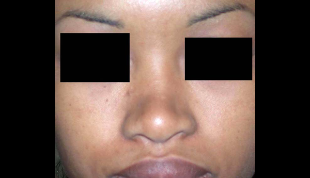 chirurgie-esthetique-interventions-nez-rhinoplasties