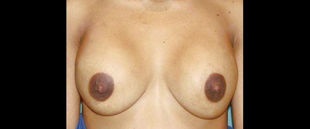 chirurgie-esthetique-interventions-chirurgie-secondaire-seins