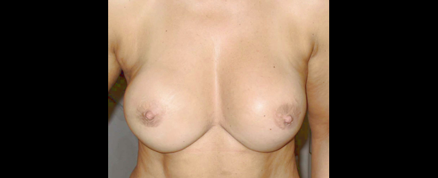 chirurgie-esthetique-interventions-chirurgie-secondaire-seins
