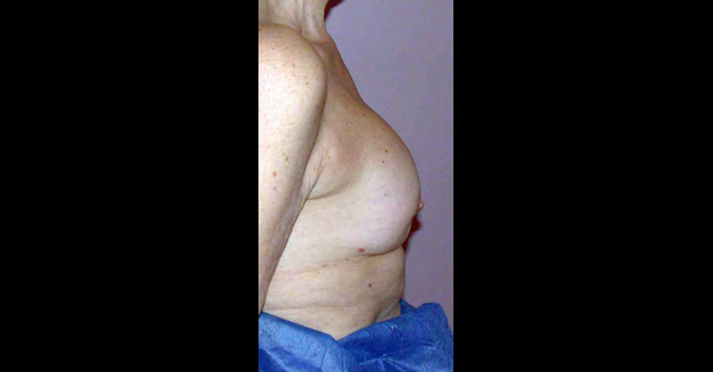 chirurgie-esthetique-interventions-chirurgie-secondaire-seins